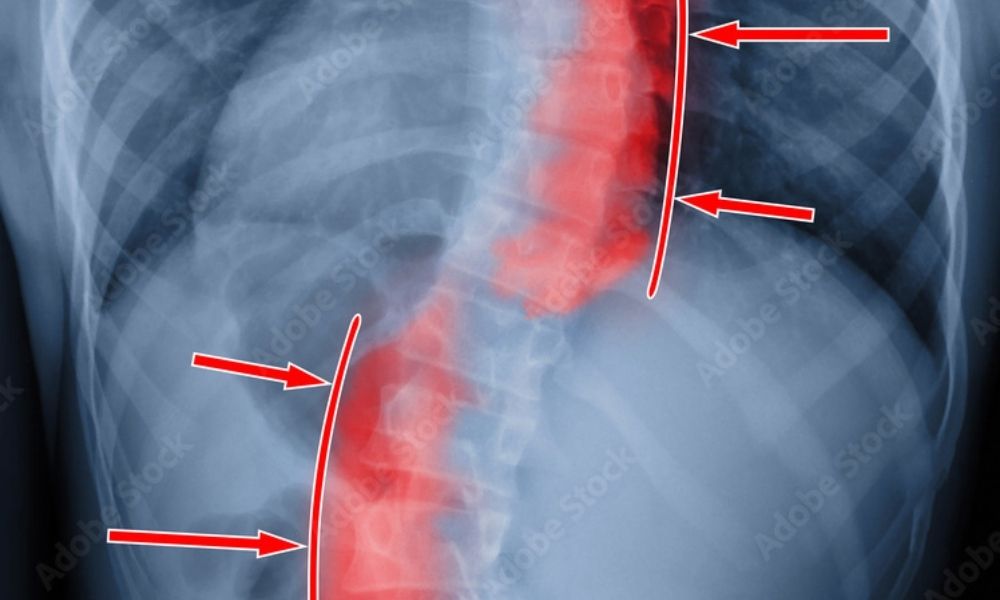 Difference Between Spinal Fusion and Vertebral Body Tethering